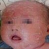 寻常型鱼鳞病有什么样的症状特点