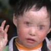 如何马上缓和鱼鳞病症状