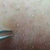 鼻子上显示粉刺 我们该怎们调理