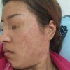 像素激光治疗粉刺痤疮会伤害皮肤吗