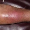 丹毒患者不能吃什么食品