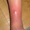 丹毒患者饮食提议