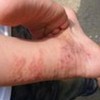 丹毒有什么好的诊疗方案