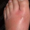 丹毒治疗新措施是啥