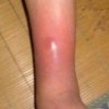 小儿丹毒易被当成感冒治