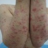 体股癣的症状表现都包含什么呢
