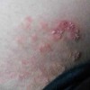 体股癣的症状全明了