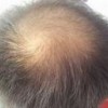脂溢性脱发怎么生发