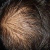 脱发日常预防保健有哪些