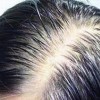 脱发怎样预防比较不错