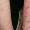 银屑病患者要吃有肉汤