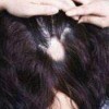 斑秃吃什么维生素