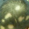 斑秃发病后常常看见的症状