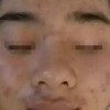 痤疮吃东西需注意些什么