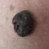 晕痣的发生特点及症状的辨别诊断