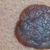 眼球结膜色素痣的特点