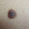 婴儿先天色素痣治疗