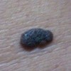 怎样去掉色素痣