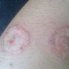 体癣患者该怎样护理呢