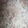 银屑病患者如何正确饮食