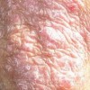 银屑病与患者的性格有无联系呢