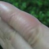 冬季需慎防手足冻伤
