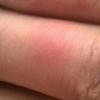 冻疮病患要上心一些事项有哪些