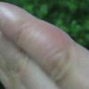 冻疮的发病特点有什么