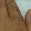 冻疮的发病特点有哪些