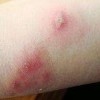 新生儿患脓疱疮该怎么办