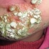 夏季孩子起脓疱疮怎么办