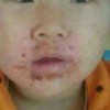 寻常性脓疱疮都表现有啥