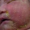 寻常性脓疱疮有哪些发病特征