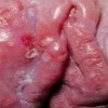 缩短生殖器疱疹对孩子的作用