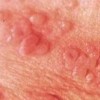 原发性生殖器疱疹的症状表现