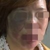 治疗太田痣的措施什么 呢