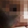 消除太田痣需用什么措施