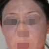 太田痣能根治吗
