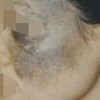 治疗太田痣特别注意