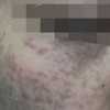 太田痣的构成要素是啥