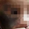 太田痣会遗传吗