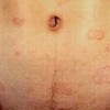 女性体股癣病患要留意那些