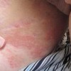 患有股癣的体现都有啥