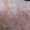 股癣症状特点是啥