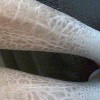 鱼鳞病对人体有啥危害