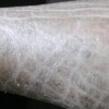 鱼鳞病对人体的伤害有什么