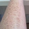 鱼鳞病不一样类型症状体现有啥