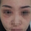 治疗面部色素斑的关键