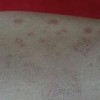 女性梅毒发病的症状