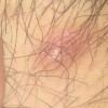 男性梅毒的早期的症状